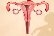 آیا آندومتریوز موجب نازایی زنان می‌شود؟

