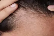 ۶ دلیل که سبب ریزش موها می‌شوند
