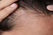 ۶ دلیل که سبب ریزش موها می‌شوند
