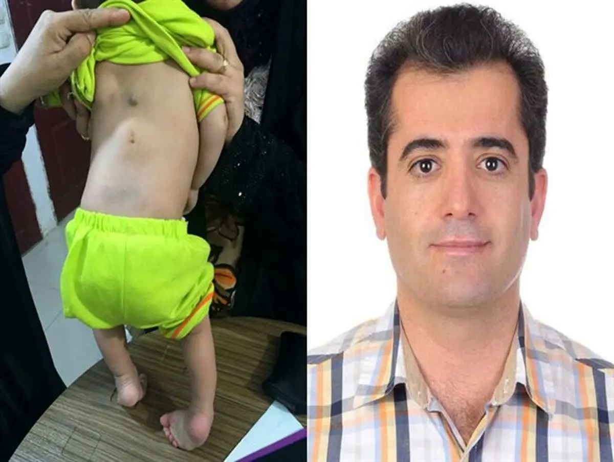 جراح کواری یکی از نادرترین ناهنجاری های مادرزادی را درمان کرد