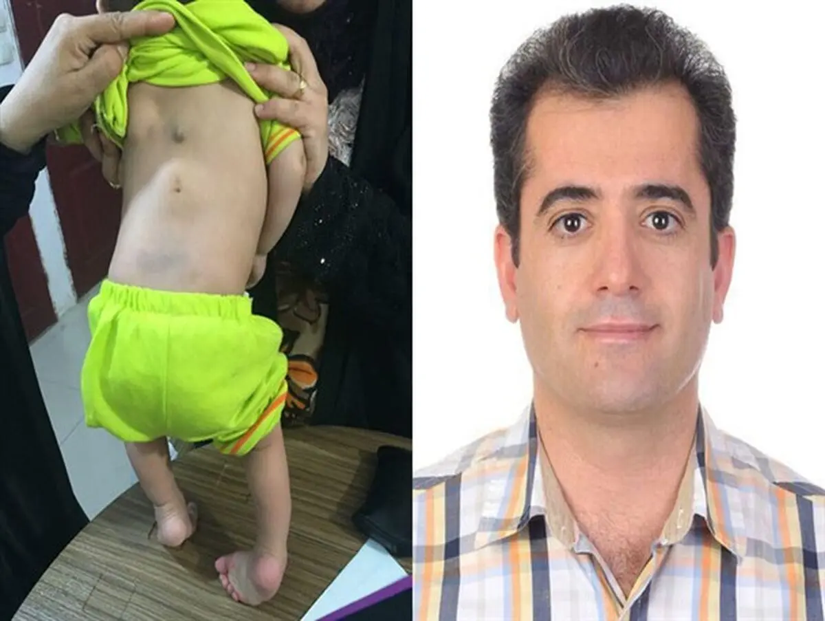 جراح کواری یکی از نادرترین ناهنجاری های مادرزادی را درمان کرد