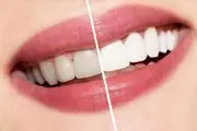 سفیدی کردن دندان با راه‌های خانگی