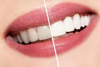راه‌های پیش‌گیری از زرد شدن دندان