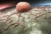 ابتلا به سرطان سینه محدودیت سنی ندارد
