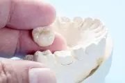 روکش دندان چیست و 3 روش عالی برای جایگزینی آن کدامند؟

