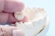 روکش دندان چیست و 3 روش عالی برای جایگزینی آن کدامند؟

