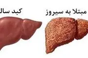 سیروز کبدی را جدی بگیرید