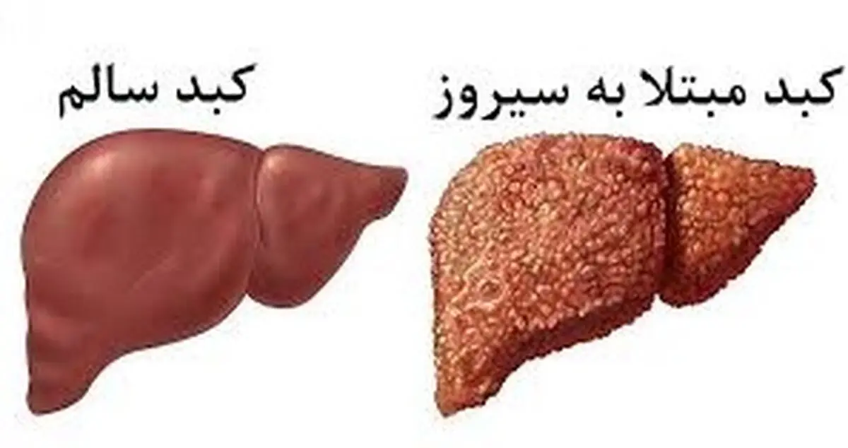 سیروز کبدی را جدی بگیرید