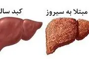 سیروز کبدی را جدی بگیرید