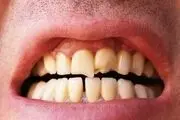 ۸ نکته برای جلوگیری از درد، تورم و خونریزی لثه
