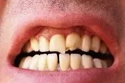 ۸ نکته برای جلوگیری از درد، تورم و خونریزی لثه
