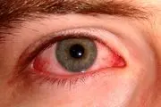 شایع‌ترین علل ابتلا به عفونت‌های چشمی