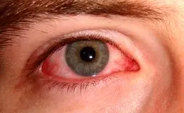 شایع‌ترین علل ابتلا به عفونت‌های چشمی