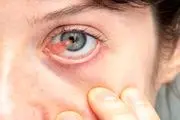 ناخنک چشم چیست؟ درمان خانگی ناخنک چشم