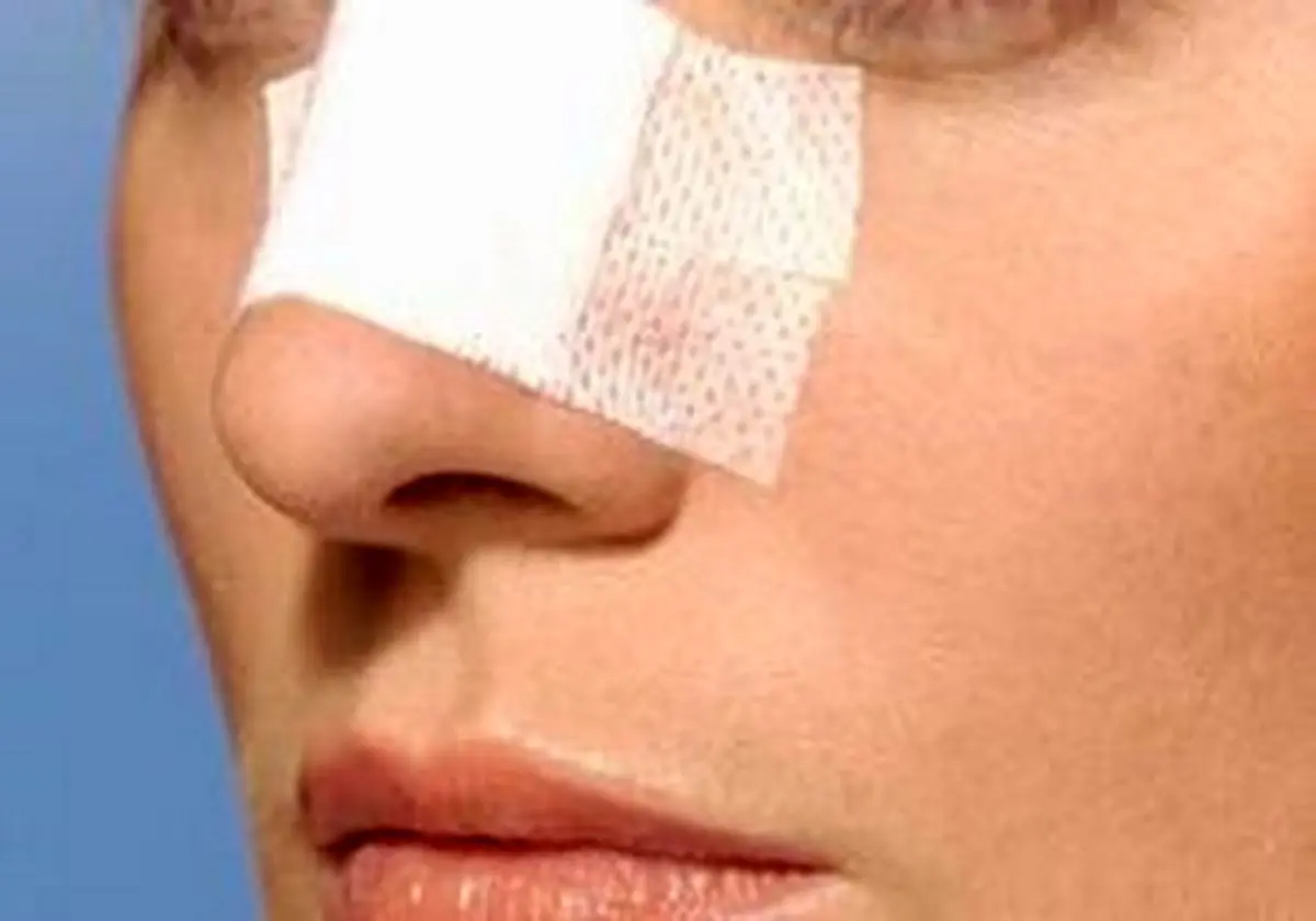 آمار جراحیهای زیبایی بینی در این روزهای کرونایی