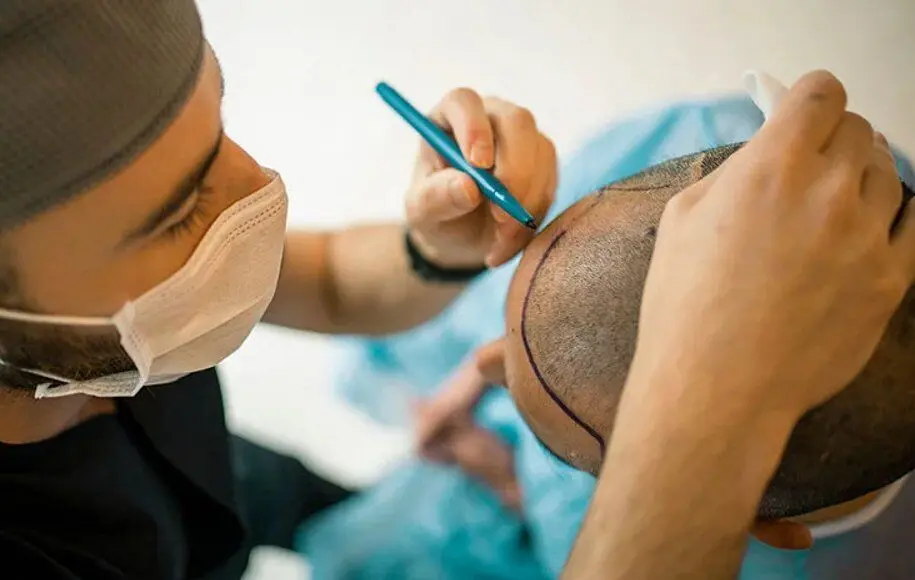 
بهای ده‌ها میلیونی برای مو داشتن/ پشت صحنه تاریک صنعت کاشت مو چه می‌گذرد؟!