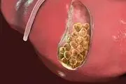 سنگ کیسه صفرا با سنگ کلیه چه فرقی دارد؟