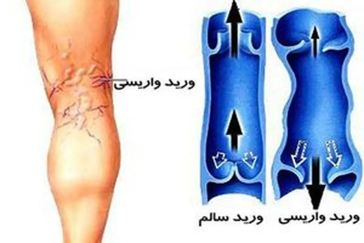 روش صحیح درمان واریس با گوجه فرنگی