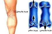 واریس پا به سراغ چه کسانی می‌رود؟