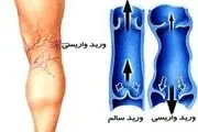 واریس پا به سراغ چه کسانی می‌رود؟
