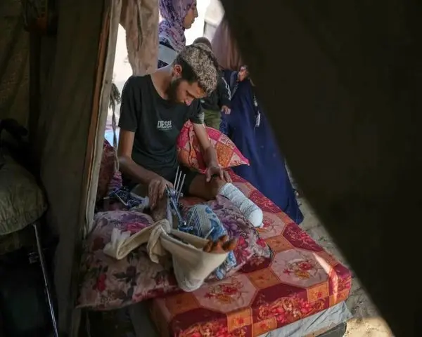 تقلای مجروحان قطع‌ عضو در غزه برای بقا