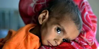صدها هزار کودک مبتلا به سوءتغذیه شدید در افغانستان 