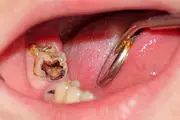 خطرناک ترین عوارض دندان خراب
