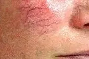 آیا می‌دانید واریس در صورت هم اتفاق می‌افتد؟!