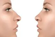 آیا به جراحی بینی فکر می کنید؟