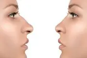 آیا به جراحی بینی فکر می کنید؟
