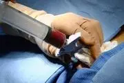 استفاده از استخوان اجساد در جراحی کودکان تهرانی 