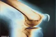 یک راه برای پیشگیری از پوکی استخوان