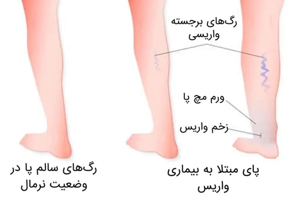 آیا درمان واریس دائمی و بدون بازگشت است؟