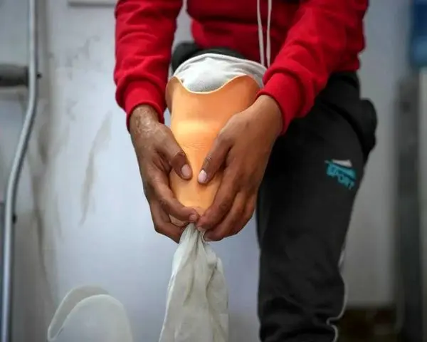 تقلای مجروحان قطع‌ عضو در غزه برای بقا