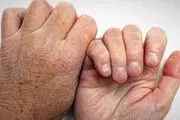 
چند درصد مردم هرگز جذام نمی گیرند؟
