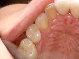 چگونه دندانهایمان را سفید کنیم؟