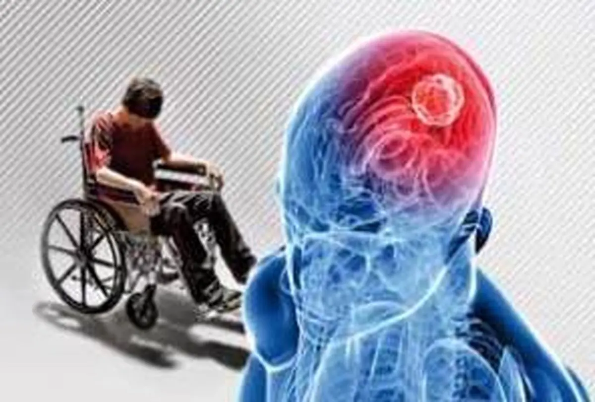 علائم رایج اماس در خانمها و آقایان
