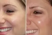 چگونه چین و چروک دور چشم را برطرف کنیم؟