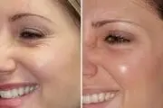 چگونه چین و چروک دور چشم را برطرف کنیم؟