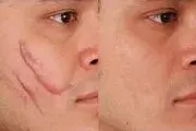  جای زخم‌ را چگونه درمان کنیم؟