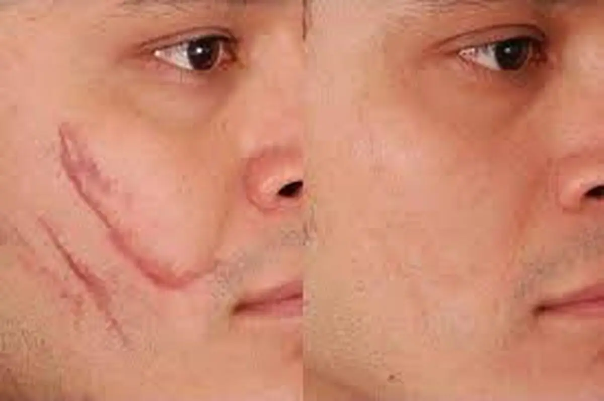  جای زخم‌ را چگونه درمان کنیم؟