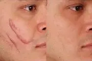  جای زخم‌ را چگونه درمان کنیم؟