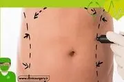 راهکارهای کاهش عوارض بعد از جراحی شکم یا ابدومینوپلاستی
