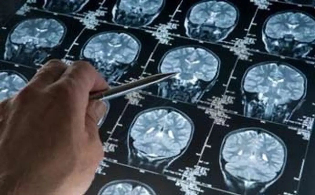 ارتباط ابتلا به آلزایمر با سطح سواد
