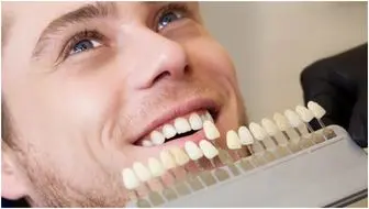  آیا کامپوزیت دندان را می‌توان در یک روز انجام داد؟