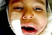 انفجار ترقه در دهان یک کودک سه ساله