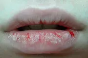 چرا لب‌ها پوسته پوسته می شود؟