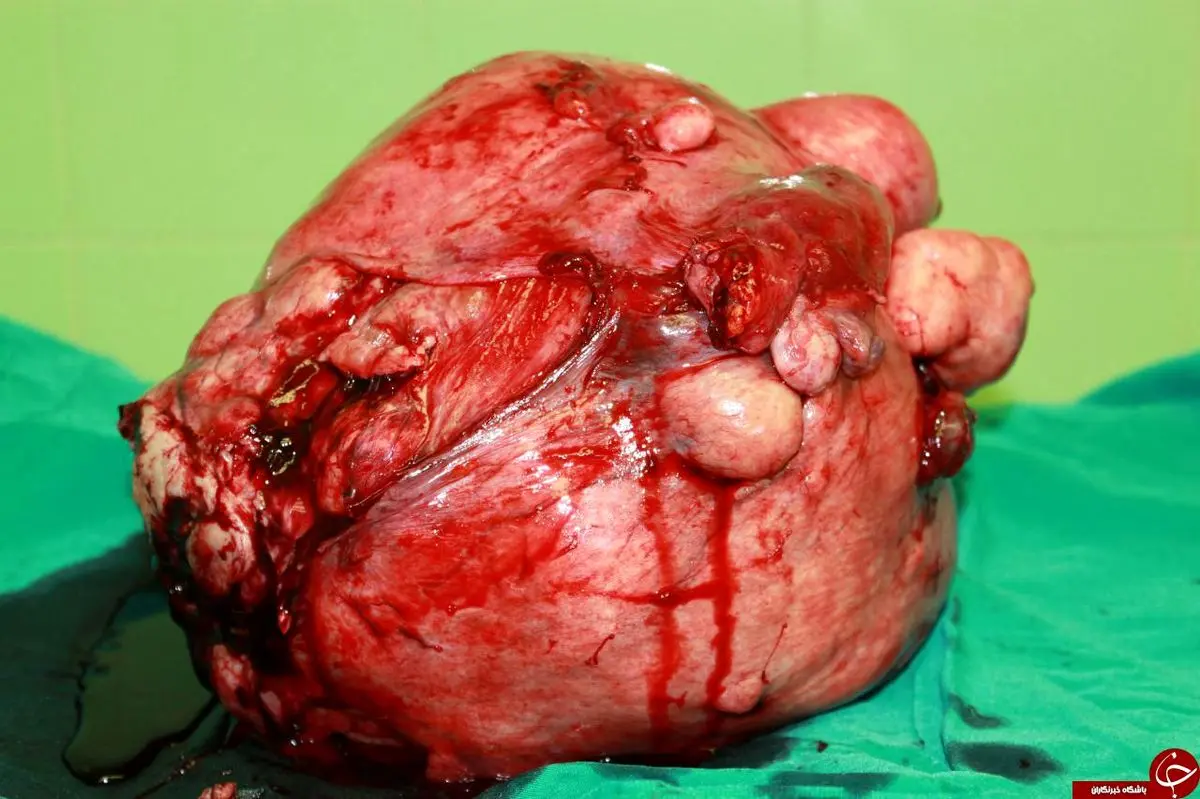 خارج کردن توده 8 کیلوگرمی از شکم خانم 50 ساله+ تصاویر