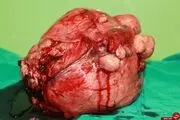 
خارج کردن توده 8 کیلوگرمی از شکم خانم 50 ساله+ تصاویر
