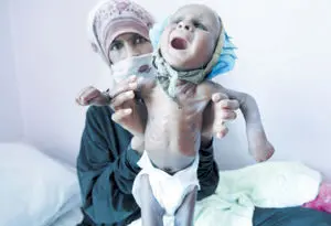 میلیون‌ها نفر در یمن در معرض خطر مرگ قرار دارند 
